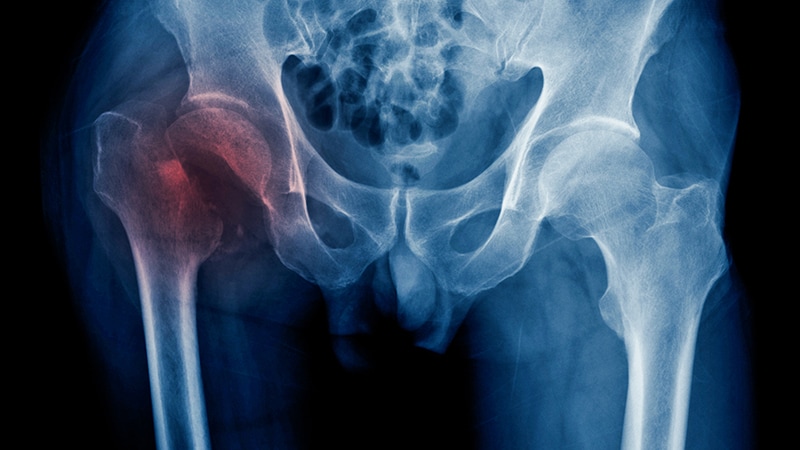 Don't Overlook Bone Health in Coeliac Disease