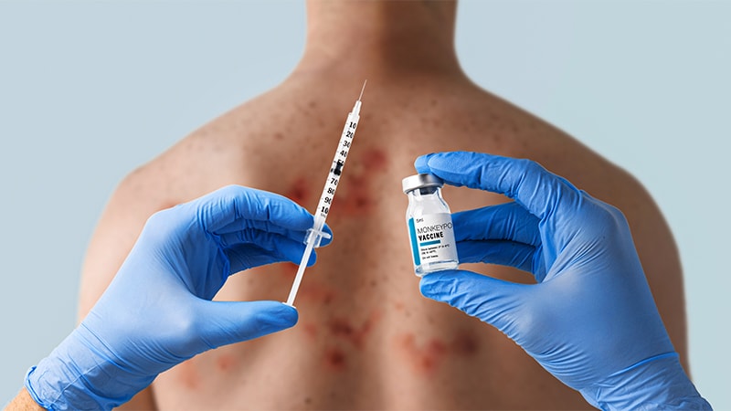 How to Stay Safe When Caring for Patients With Mpox